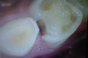歯間のむし歯