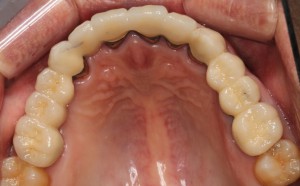 セラミックの白い歯