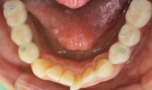 セラミックの白い歯