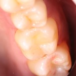 歯を残す治療