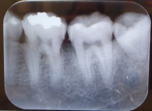 歯石